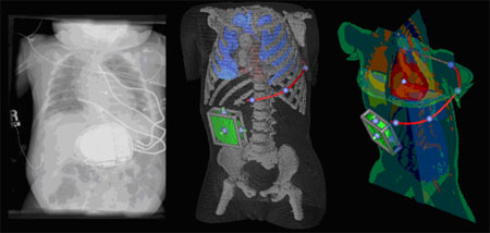 icd placement fig1