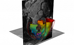 Trayanova Predicting Ablation Targets 2 pyramid